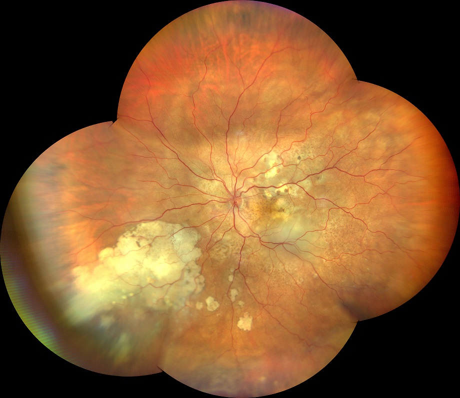 Retinopatia da presunta bartonellosi monolaterale